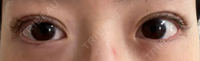 二重埋没 湘南美容クリニック 京都院 DAY 0 メイン用