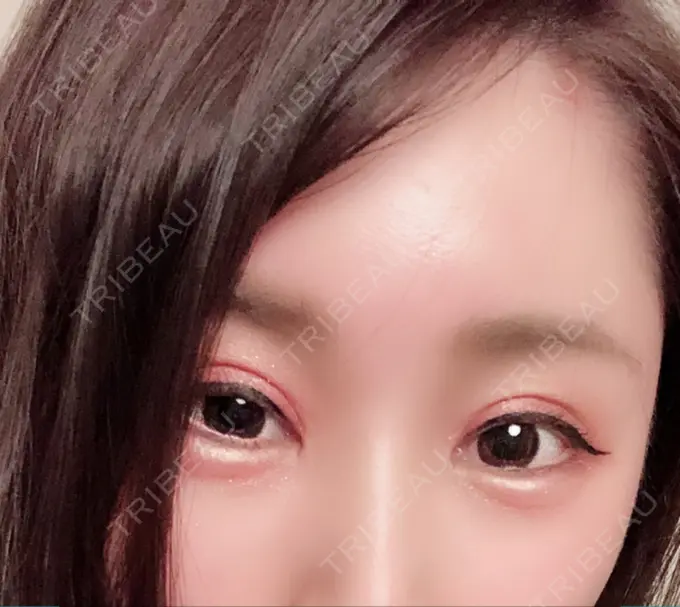 二重切開 / 眼瞼下垂（切開） / 目尻切開 / タレ目形成・グラマラスライン（切開） / 前額リフト レアート整形外科 DAY 30 メイン用