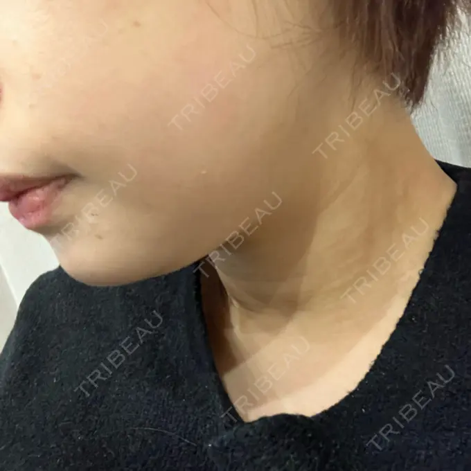 ハイフ（顔） 湘南美容クリニック 仙台院 DAY 9 メイン用