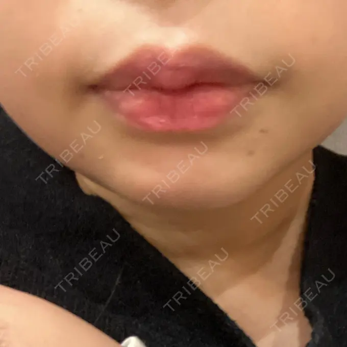 ハイフ（顔） 湘南美容クリニック 仙台院 DAY 9 メイン用