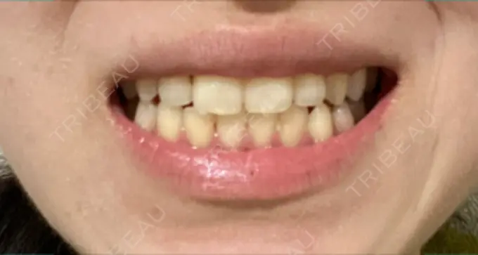 ホワイトニング オーラルビューティークリニック クラリス審美歯科・矯正歯科 DAY 6 メイン用