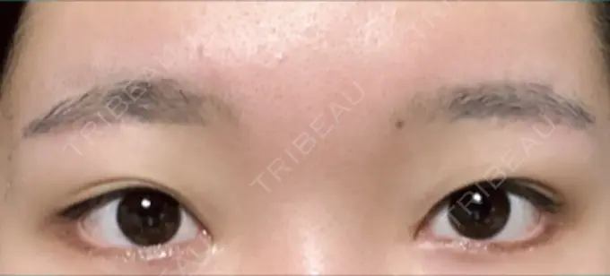 タレ目形成・グラマラスライン（切開） / 目尻靭帯移動 DIVINE（ディバイン）整形外科 DAY 22 メイン用