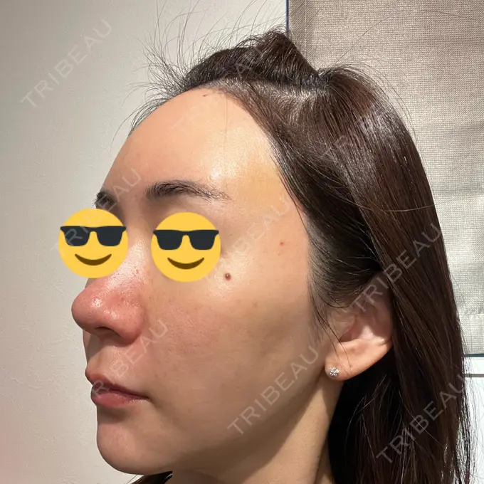 その他（肌） オールリティング整形外科 DAY 9 メイン用