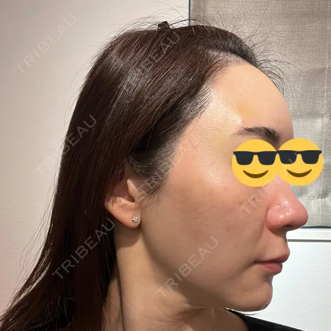 その他（肌） オールリティング整形外科 DAY 9 メイン用