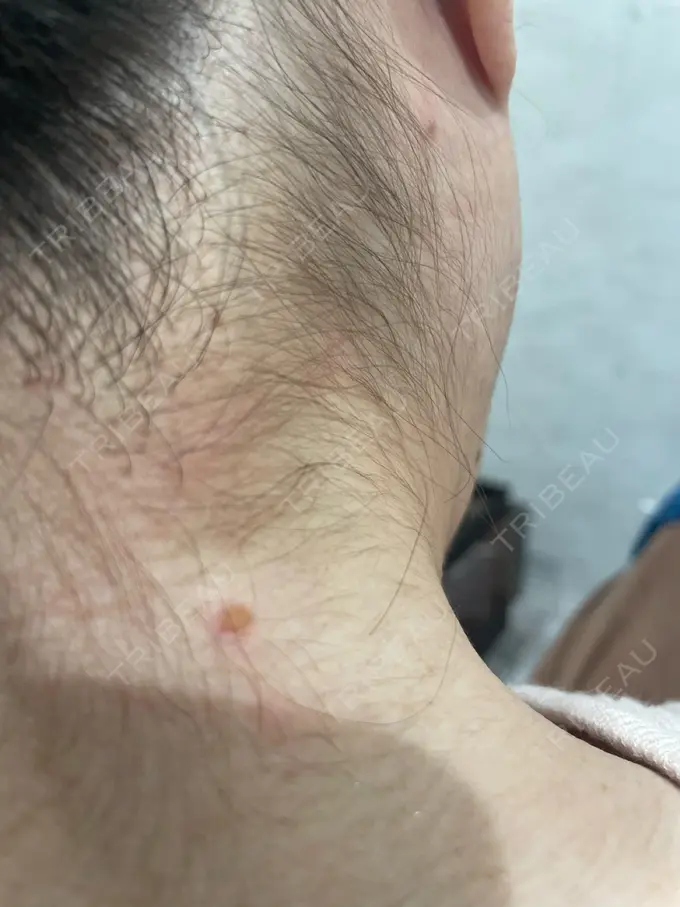 ほくろ・いぼ除去レーザー（肌） 美容皮膚科エルムクリニック 岡山院 DAY 0 メイン用