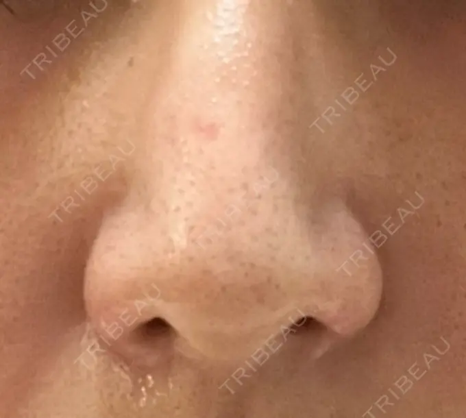 鼻孔縁挙上 くさのたろうクリニック DAY 12 メイン用