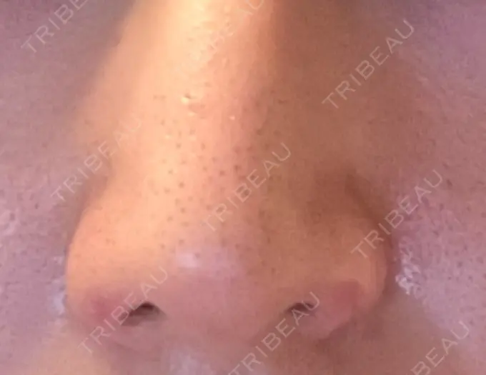 鼻孔縁挙上 くさのたろうクリニック DAY 20 メイン用