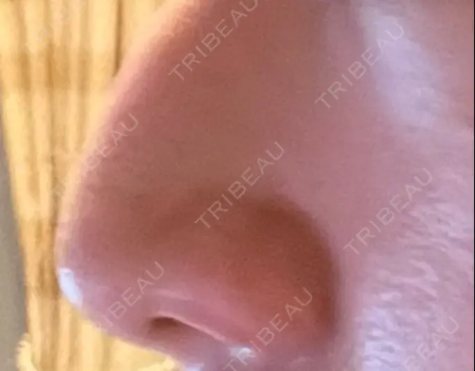 鼻孔縁挙上 くさのたろうクリニック DAY 20 メイン用