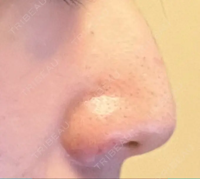 鼻孔縁挙上 くさのたろうクリニック DAY 20 メイン用