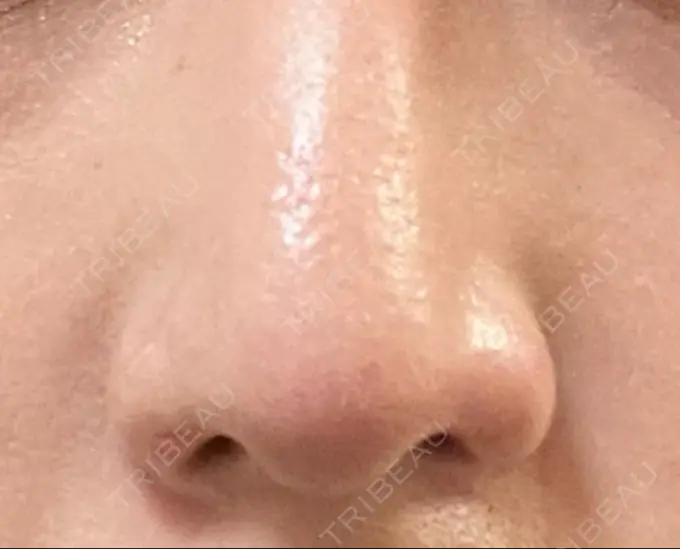 鼻孔縁挙上 くさのたろうクリニック DAY 42 メイン用