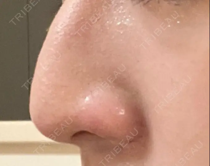 鼻孔縁挙上 くさのたろうクリニック DAY 42 メイン用