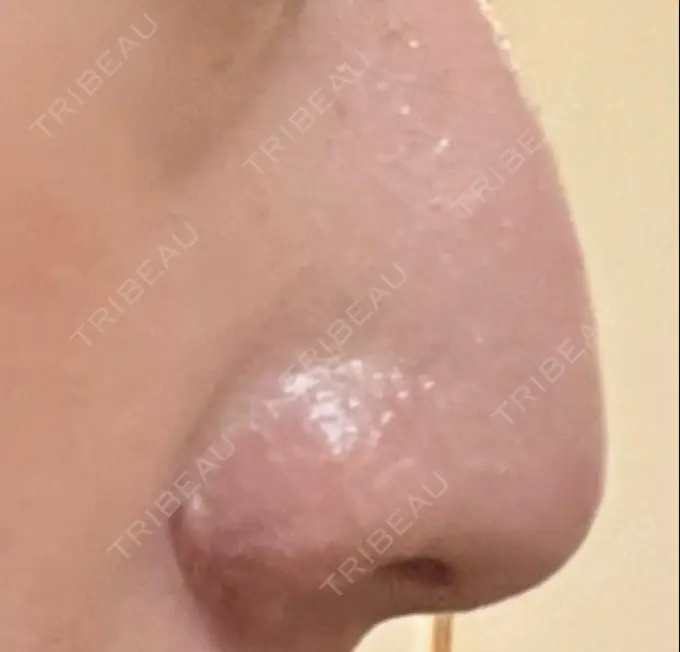 鼻孔縁挙上 くさのたろうクリニック DAY 42 メイン用