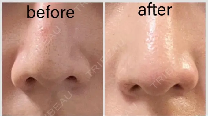 鼻孔縁挙上 くさのたろうクリニック AFTER メイン用