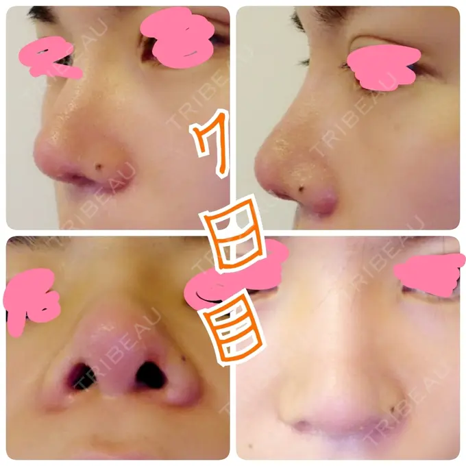隆鼻術 / 鼻尖形成（切開） / 鼻尖縮小 ヤスミクリニック DAY 7 メイン用