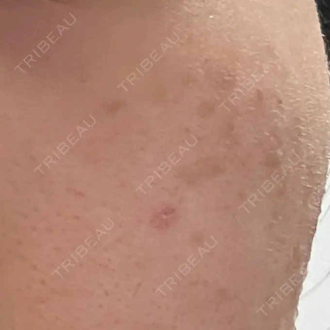 ピコスポット LOUIS CLINIC 二子玉川院【ルイクリニック】 AFTER メイン用