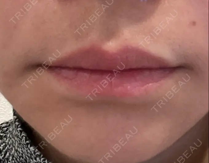 ボトックス（人中） veary clinic AFTER メイン用