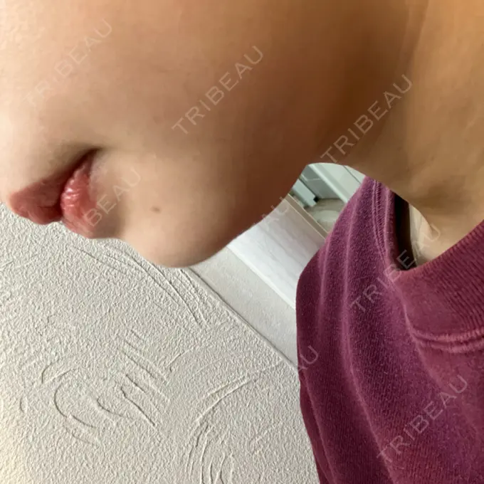 ハイフ（顔） 湘南美容クリニック 仙台院 DAY 12 メイン用