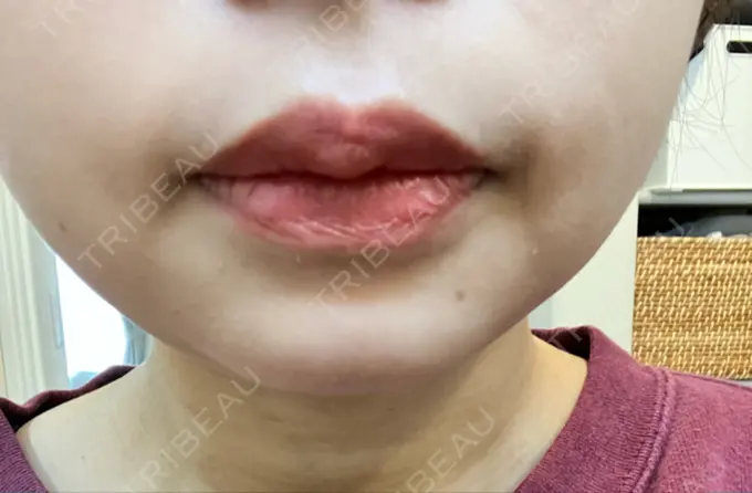 ハイフ（顔） 湘南美容クリニック 仙台院 DAY 12 メイン用