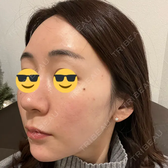 その他（肌） オールリティング整形外科 DAY 10 メイン用