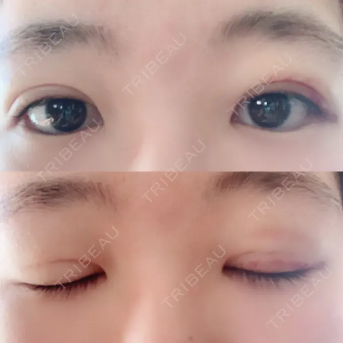 二重埋没 湘南美容クリニック 仙台院 DAY 10 メイン用