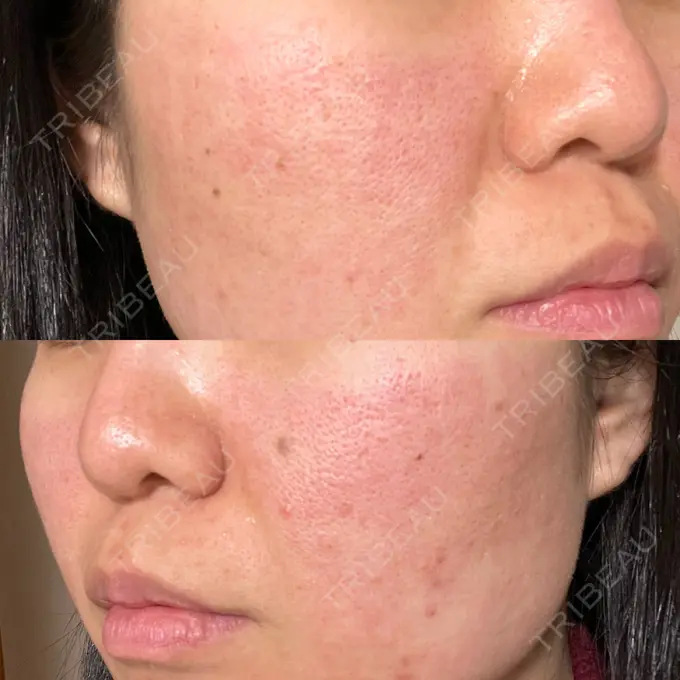 ピーリング（ニキビ・毛穴） / ポテンツァ A CLINIC（エークリニック） 仙台院 DAY 0 メイン用