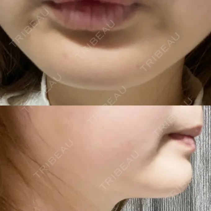 ボトックス（あご） / ボトックス（エラ・小顔） / ボトックス（眉間） M'sクリニック【エムズクリニック】 DAY 6 メイン用