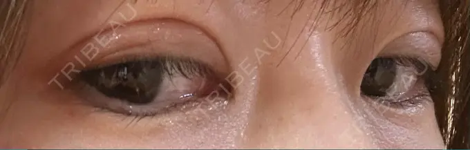 二重埋没 銀座S美容・形成外科クリニック DAY 42 メイン用