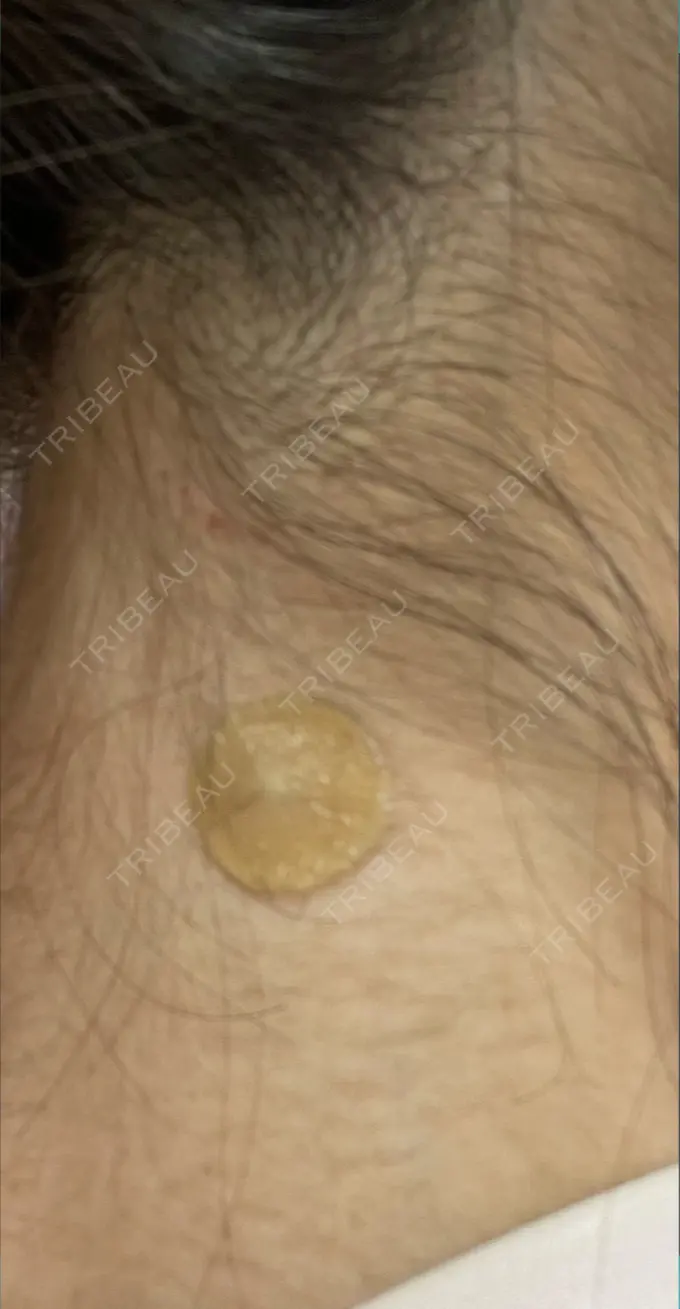 ほくろ・いぼ除去レーザー（肌） 美容皮膚科エルムクリニック 岡山院 DAY 4 メイン用