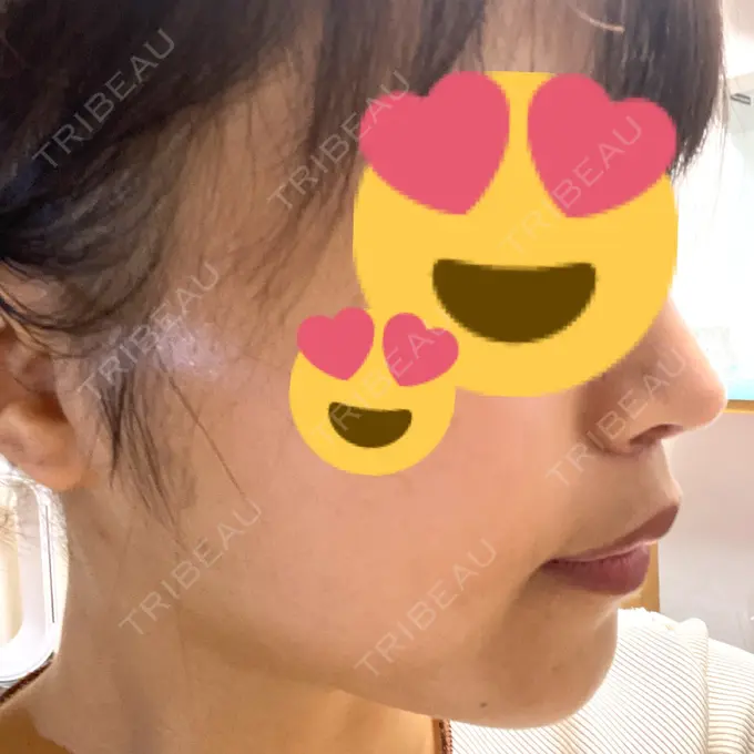 糸リフト / 脂肪吸引（顔） / ボトックス（エラ・小顔） RIVER CLINIC（リバークリニック） DAY 25 メイン用