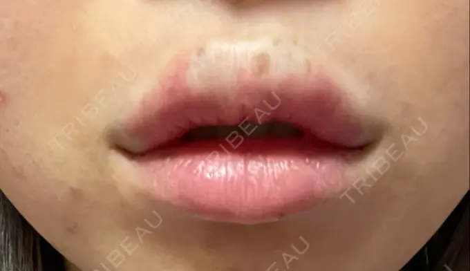 ボトックス（エラ・小顔） / ヒアルロン酸注入（唇） / ボトックス（口角） フィラークリニック 大阪梅田院 DAY 0 メイン用