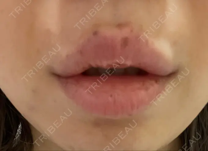 ボトックス（エラ・小顔） / ヒアルロン酸注入（唇） / ボトックス（口角） フィラークリニック 大阪梅田院 DAY 1 メイン用