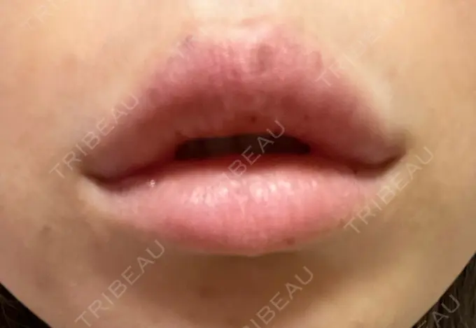 ボトックス（エラ・小顔） / ヒアルロン酸注入（唇） / ボトックス（口角） フィラークリニック 大阪梅田院 DAY 1 メイン用