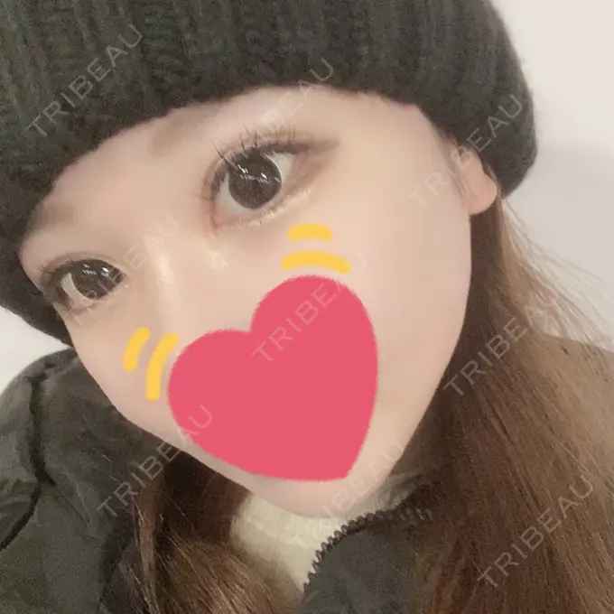 二重埋没 / 目頭切開 Brandnew Beauty Clinic DAY 58 メイン用