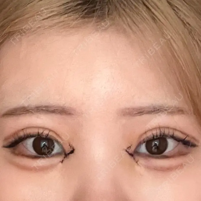 二重埋没 / 目頭切開 / 自然癒着法 AI Beauty Clinic （エーアイ美容クリニック） DAY 3 メイン用