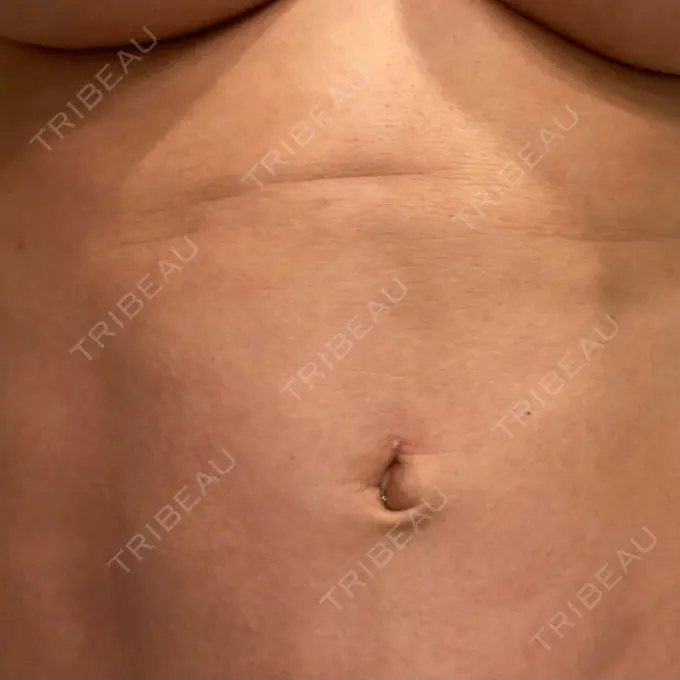 脂肪吸引（二の腕） / 脂肪吸引（お腹） / 豊胸（脂肪注入） / 脂肪吸引（肩） Casa de GRACIA GINZA 【カーサデグラシアギンザ】 AFTER メイン用