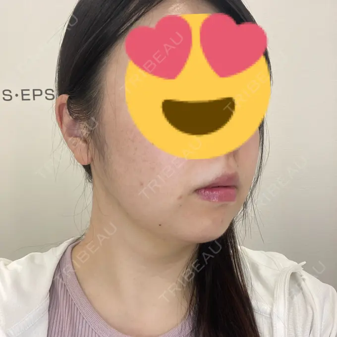 脂肪吸引（顔） Mods Clinic（モッズクリニック） 福岡院 DAY 30 メイン用