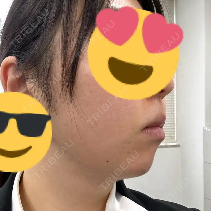 脂肪吸引（顔） Mods Clinic（モッズクリニック） 福岡院 DAY 99 メイン用