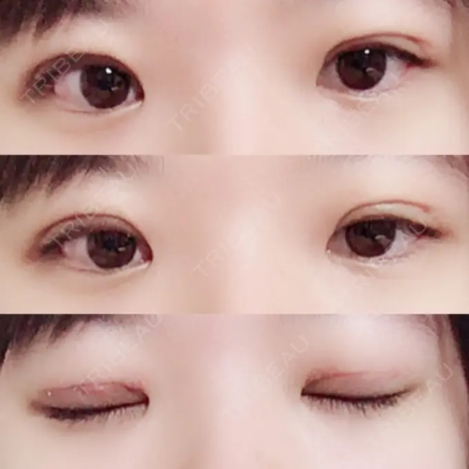 二重切開 / 上まぶたの脂肪取り 聖心美容クリニック 横浜院 DAY 9 メイン用