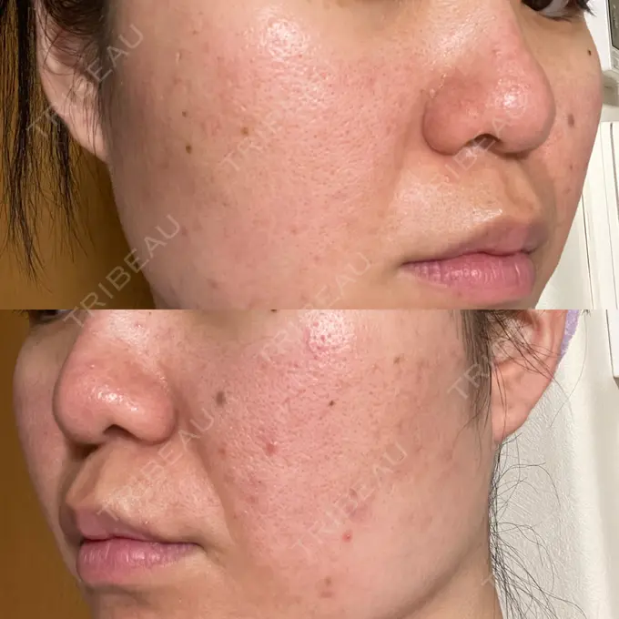 ピーリング（ニキビ・毛穴） / ポテンツァ A CLINIC（エークリニック） 仙台院 DAY 2 メイン用