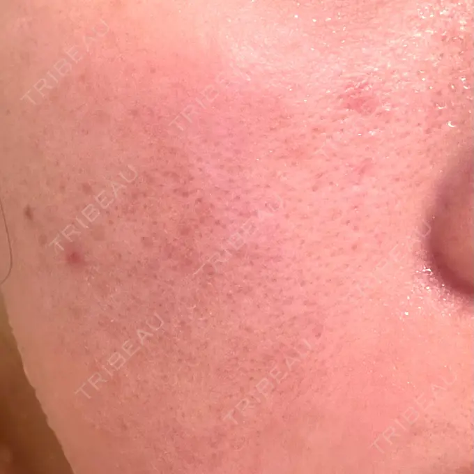 ピーリング（ニキビ・毛穴） / ニキビ治療 Mavie Beauty Clinic （マヴィービューティークリニック） DAY 2 メイン用