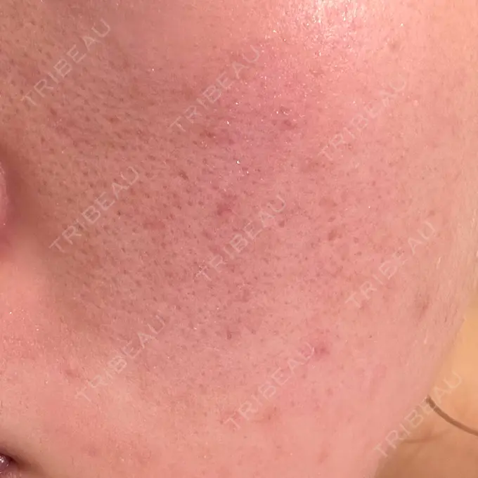 ピーリング（ニキビ・毛穴） / ニキビ治療 Mavie Beauty Clinic （マヴィービューティークリニック） DAY 2 メイン用