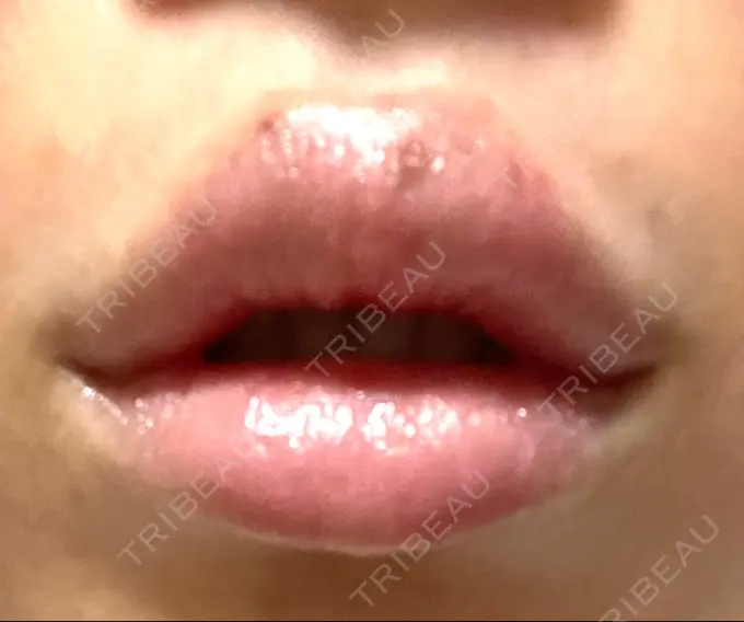 ボトックス（エラ・小顔） / ヒアルロン酸注入（唇） / ボトックス（口角） フィラークリニック 大阪梅田院 DAY 2 メイン用