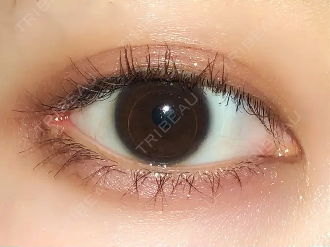 目頭切開 / 目尻切開 エートップ美容整形外科 AFTER メイン用