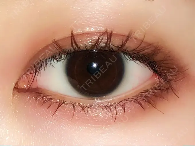 目頭切開 / 目尻切開 エートップ美容整形外科 DAY 370 メイン用