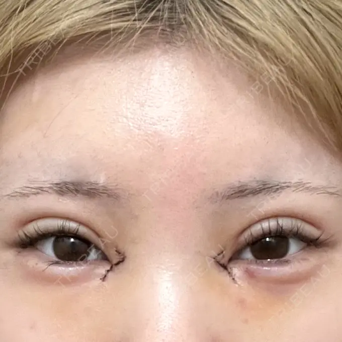 二重埋没 / 目頭切開 / 自然癒着法 AI Beauty Clinic （エーアイ美容クリニック） DAY 5 メイン用