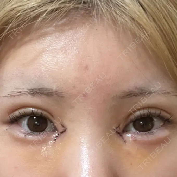 二重埋没 / 目頭切開 / 自然癒着法 AI Beauty Clinic （エーアイ美容クリニック） DAY 5 メイン用