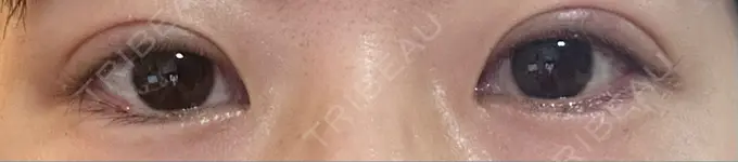 二重埋没 銀座S美容・形成外科クリニック DAY 44 メイン用