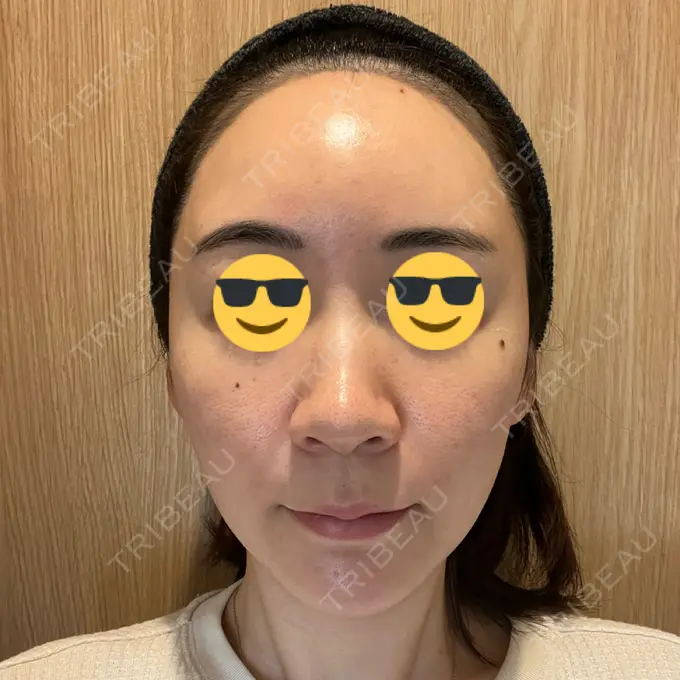 その他（肌） オールリティング整形外科 AFTER メイン用