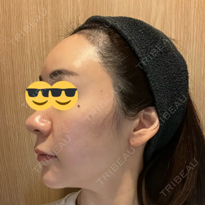 その他（肌） オールリティング整形外科 DAY 15 メイン用