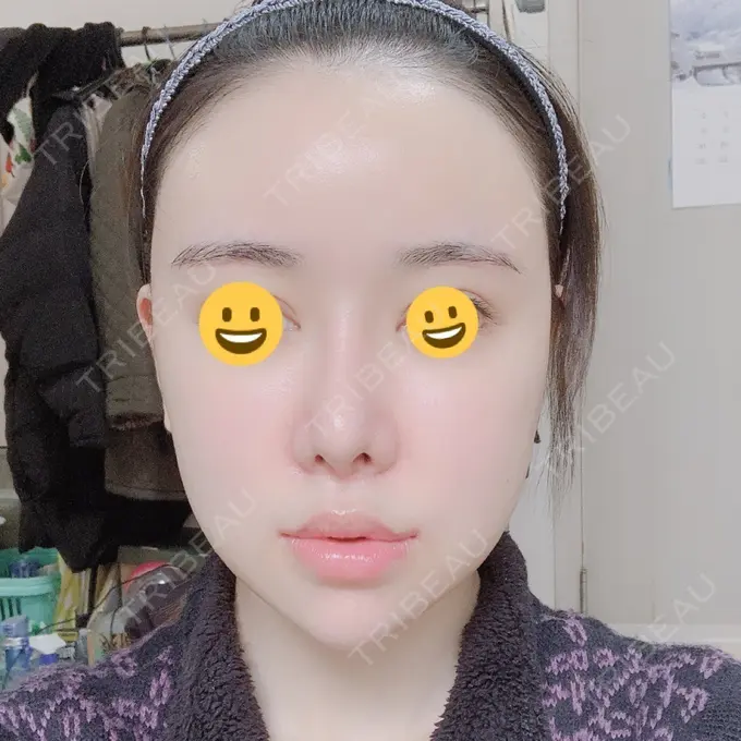 脂肪注入（肌） / 脂肪注入（額） / 脂肪注入（輪郭） スノウ（Snow）整形外科 DAY 16 メイン用